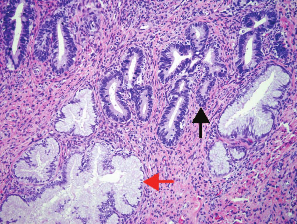 adenocarcinoma in situ (AIS) are not known. Approximately half of the lesions are associated with high-grade squamous intraepithelial lesion.