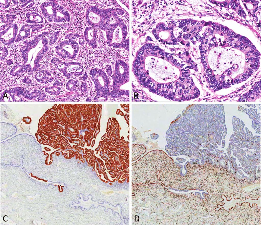 Figure 2. Usual adenocarcinoma of the cervix. A, Medium-power appearance of infiltrating neoplastic glands.