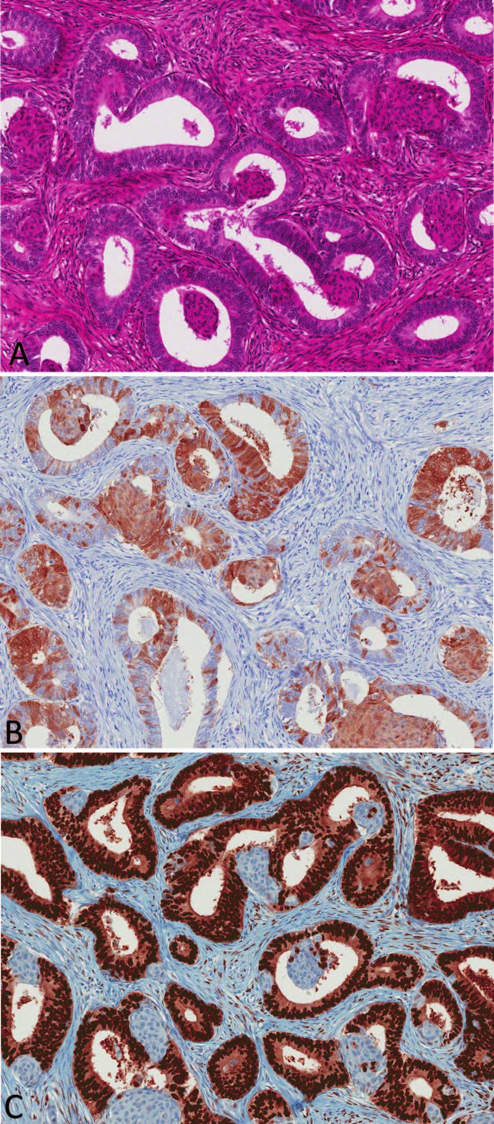 Figure 3. Uterine endometrioid adenocarcinoma. A, Well-differentiated endometrioid adenocarcinoma with squamous morulae.