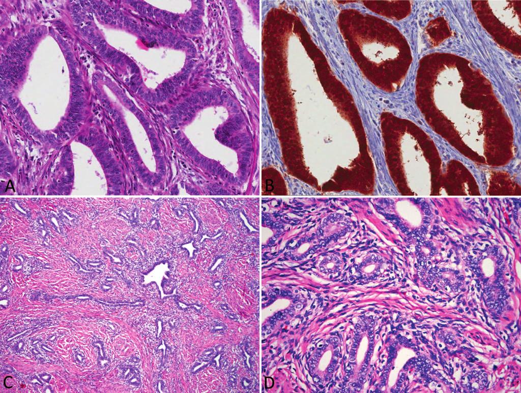 Figure 4. Cervical endometrioid adenocarcinoma. A, Medium-power appearance of cervical endometrioid adenocarcinoma showing glands with deep eosinophilic cytoplasm.