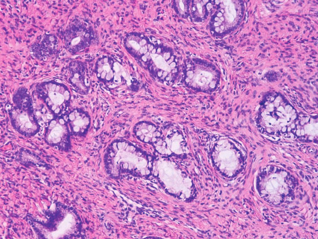 C, Cervical endometrioid adenocarcinoma, minimal deviation type; low-power appearance of haphazard cervical infiltration by bland-appearing glands.