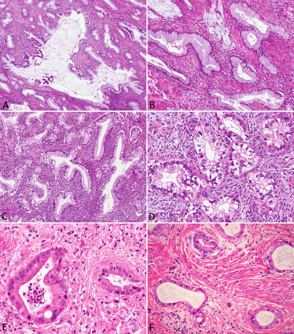 Figure 7. Gastric adenocarcinoma of the cervix. A, Gastric adenocarcinoma, minimal-deviation type. Low-power appearance of diffuse cervical infiltration by irregular and cystically dilated glands.