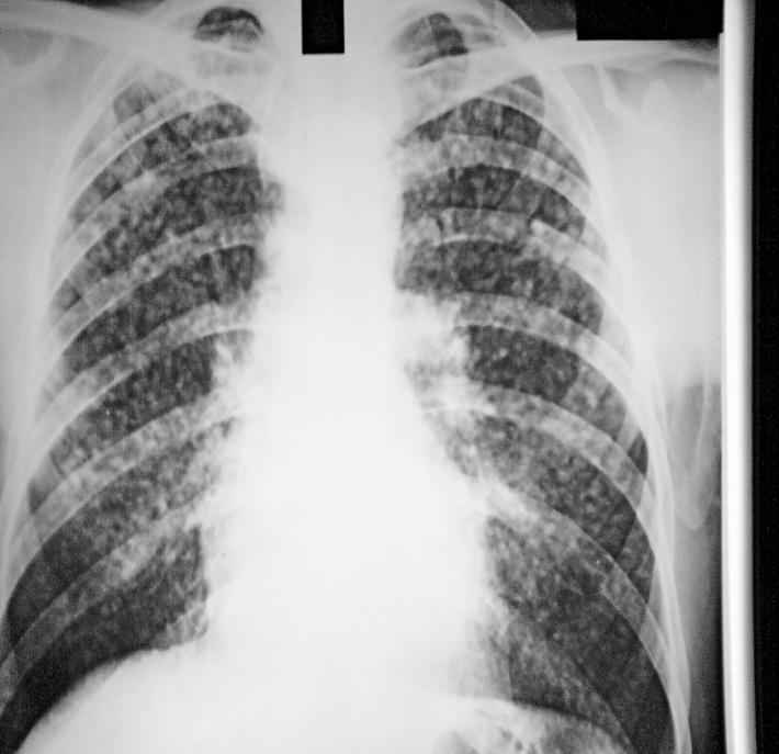 Silicosis: diffuse fibrosis of the lungs due to