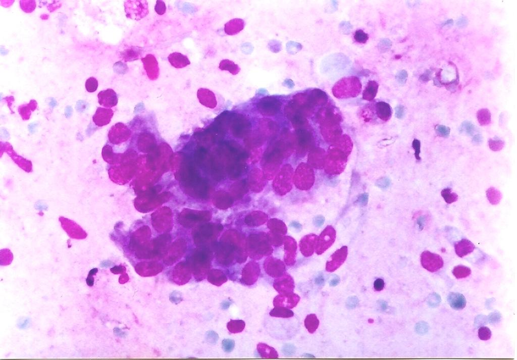 In one case of Hodgkin s disease, Reed Sternberg cells and Hodgkin cells were much easier recognized in monolayers. In this case immunocytochemistry was performed.
