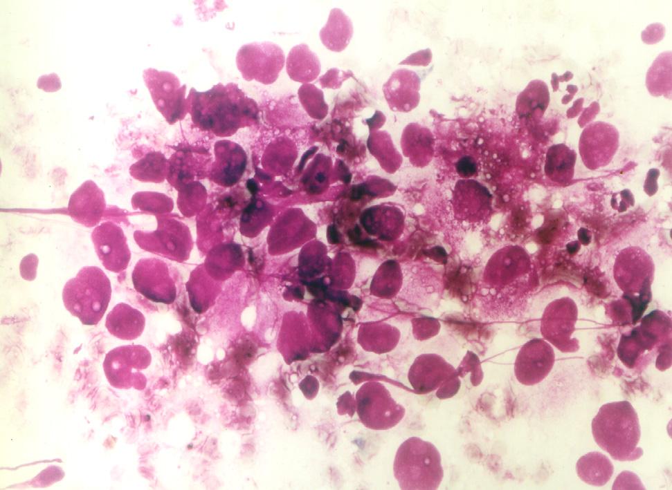Discussion Figure 9 Thyroid papillary carcinoma. FNAC. Liquid based preparation. May-Grünwald Giemsa stain, 100.