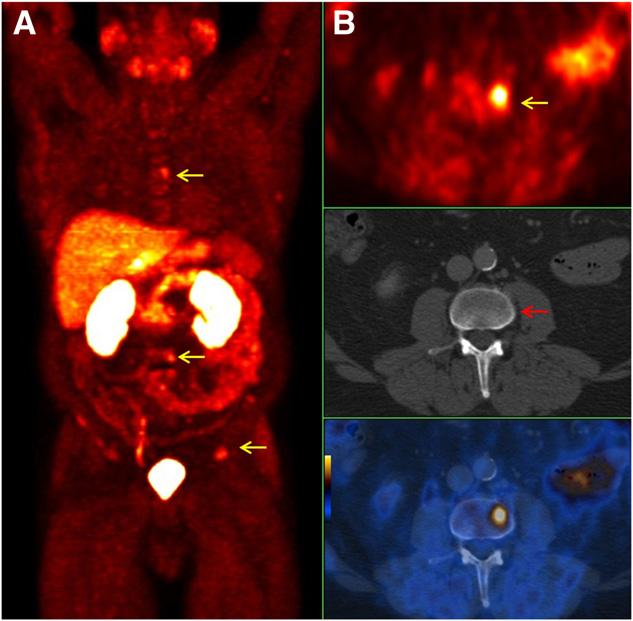 RGB FIGURE 2. A 64-y-old prostate cancer patient (pt3a, N0, R0, Gleason score of 7, primary PSA level of 1.34 ng/ml) with increasing PSA level of 4.7 ng/ml 3 mo after radiotherapy.