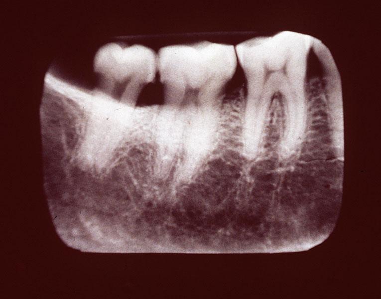 Mandibular molars - Angle of