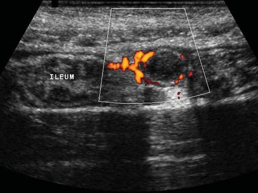 , Transverse power Doppler sonogram shows hypervascularity of appendiceal wall. Fig. 4 43-year-old man with appendicitis.