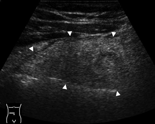 , Unenhanced CT depicts lesion as cakelike area of slightly dense inflamed omental fat (arrowheads) larger than in epiploic appendagitis and