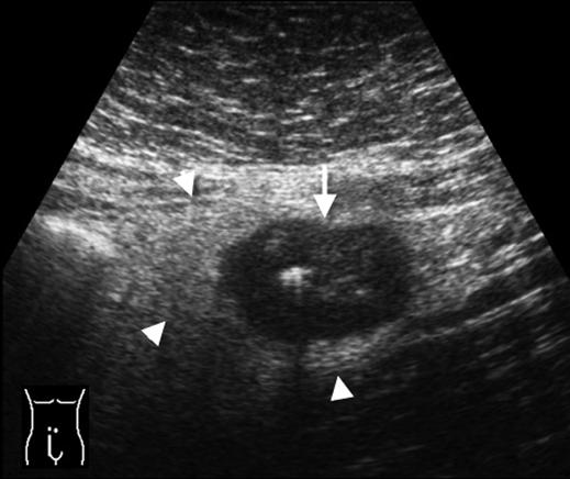 Genitourinary Tract Gynecologic conditions such as pelvic inflammatory disease or a hemorrhagic functional ovarian cyst can cause acute pelvic pain that may simulate appendicitis.