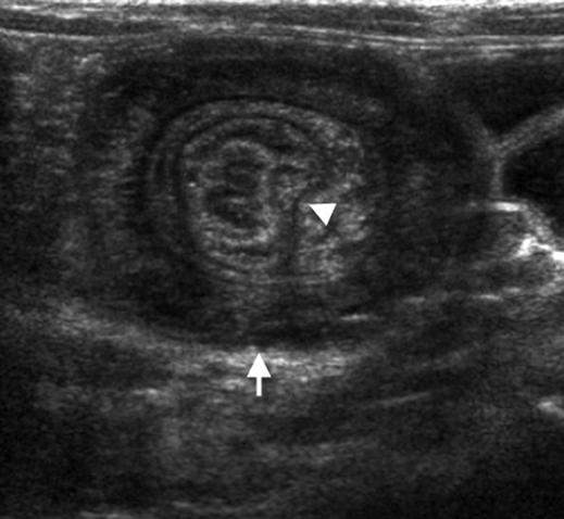 van reda Vriesman and Puylaert Fig. 13 2-year-old boy with ileocecal intussusception.