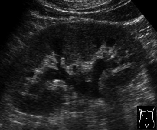 and, Sonograms show right-sided hydronephrosis () and obstructing calculus (, arrow) in distal ureter at level of iliac artery () and iliac vein (V).