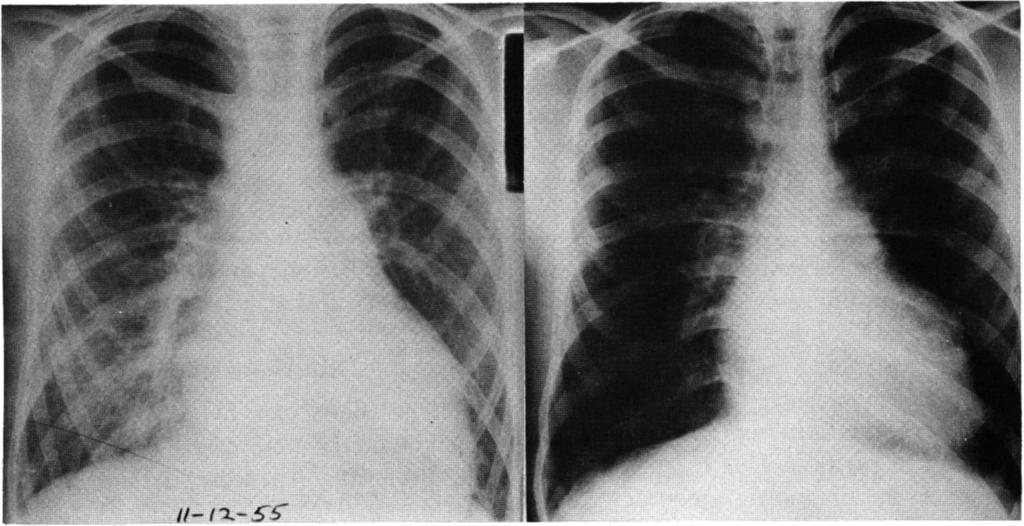 640 GEORGE W. B. STARKEY, ^H^CHEST FIGURE 1: Congenital mitral stenosis. Left: Preoperative x-ray film of 12-year-old boy in chronic heart failure.