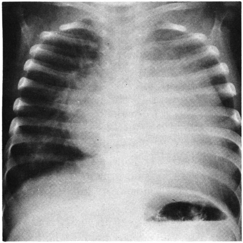 642 GEORGE W. B. STARKEY Diseases of the Chest FIGURE 3: Congenital mitral insufficiency. Left: Preoperative x-ray film of 15-month-old patient in congestive heart failure.