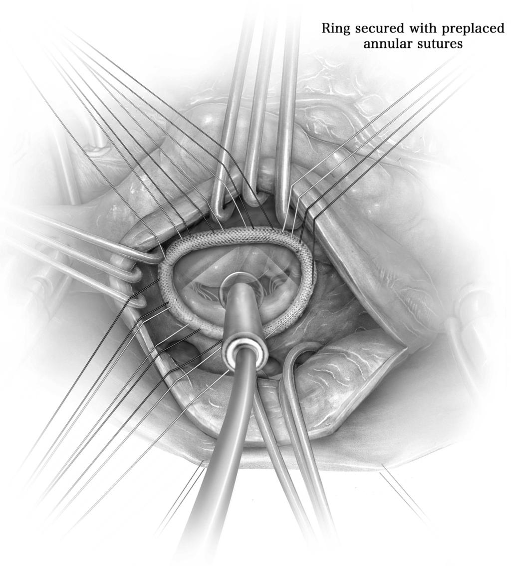 Repair techniques for ischemic mitral regurgitation 207 Figure 4 A complete, semirigid annuloplasty ring is then appropriately sized to the surface area of the valve.