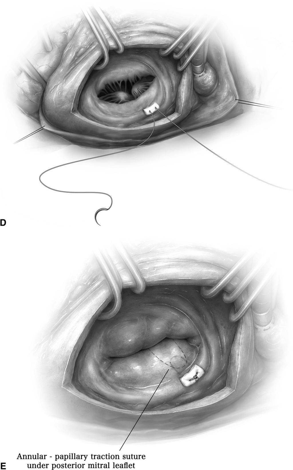 Repair techniques for ischemic mitral regurgitation 211 Figure 7 (continued) (D) The traction suture is passed through the mitral annulus and felt pledget to complete placement of the stitch.