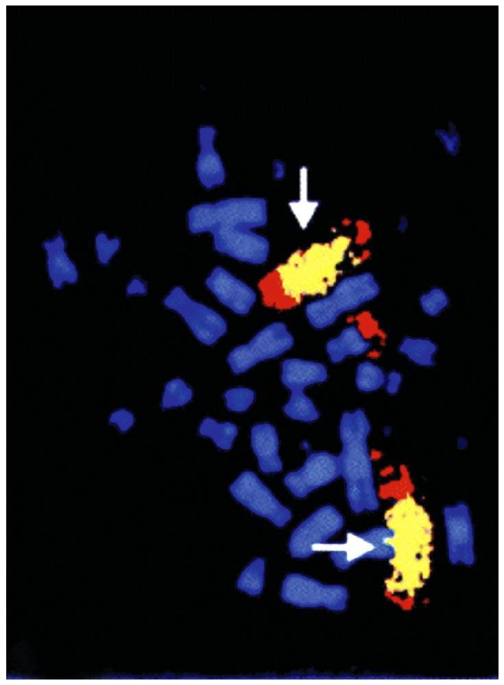 4.5 The myc oncogene can arise via at least three distinct mechanisms homogeneous staining regions (HSR) The N-myc gene amplification is found in 30% of human childhood neuroblastoma.