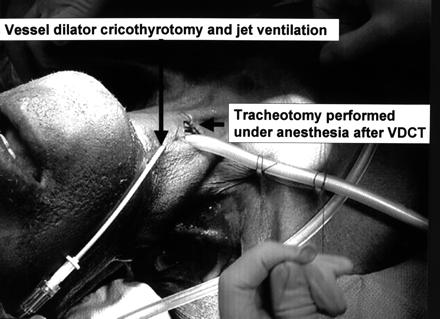 Emergency Cricothyrotomy Canadian Journal of Anesthesia 52:765-769