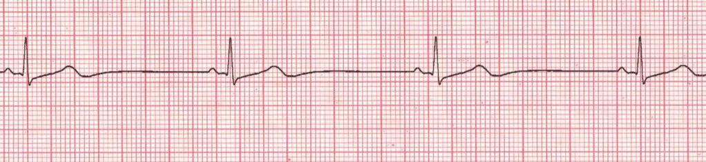 Sinus Bradycardia (Sinus rhythm with a rate less than 50) Is your patient stable or unstable?