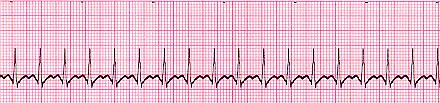 For an unstable Mobitz type II second-degree or third-degree heart block patient be prepared for transcutaneous pacing Supraventricular Tachycardia - SVT (SUSTAINED rapid narrow complex tachycardia