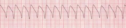 If vagal maneuvers aren t successful in slowing their heart rate, administer 6 mg. of Adenosine. What is unique about administering Adenosine is that it is a fast-push and fast-acting drug.