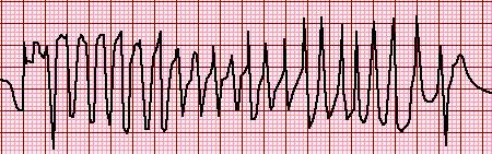With a PULSE and STABLE, treat with adenosine only if regular and monomorphic. Consider antiarrhythmic infusion i.e. Procainamide or Amiodarone IV drip.