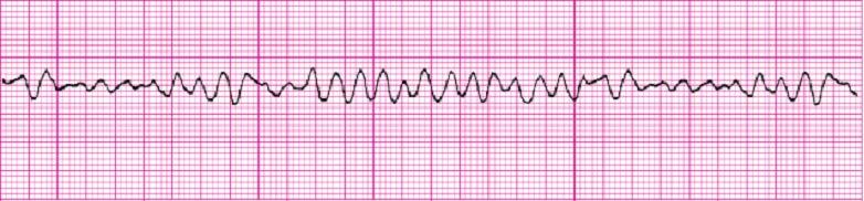 VENTRICULAR FIBRILLATION- VFib is a chaotic and disorganized rhythm that generates absolutely no perfusion! The heart is quivering as it is dying and requires IMMEDIATE defibrillation do not delay!