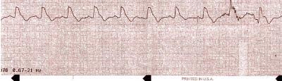 Pulseless Electrical Activity (PEA) Electrical Activity without mechanical contractility rhythm without a pulse NO PULSE What do you do if you are in a code and you find an organized rhythm on the