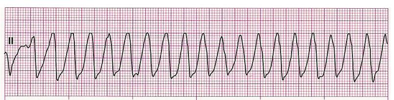 Questions 4 through 6 pertain to the following scenario. An 81-year-old woman is complaining of a sudden onset of palpitations. She denies chest pain or shortness of breath.