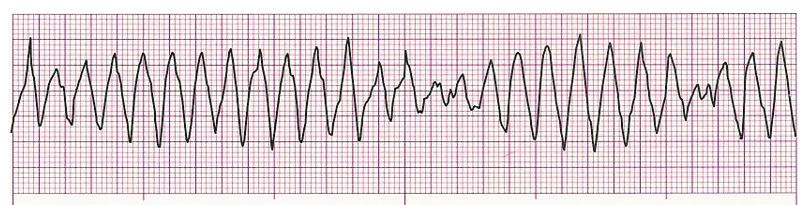 Questions 10 through 12 pertain to the following scenario. A 49-year-old man with a history of an irregular heartbeat presents with an acutely altered mental status.