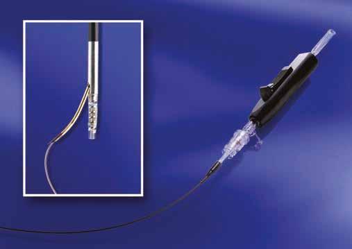 OUTBACK LTD Re-Entry Product Overview The OUTBACK LTD Re-Entry is a single lumen catheter designed to gain re-entry to the true lumen when stuck in the subintimal space.