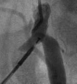 Sheath access is obtained from the other side; placing a diagnostic catheter contralateral from