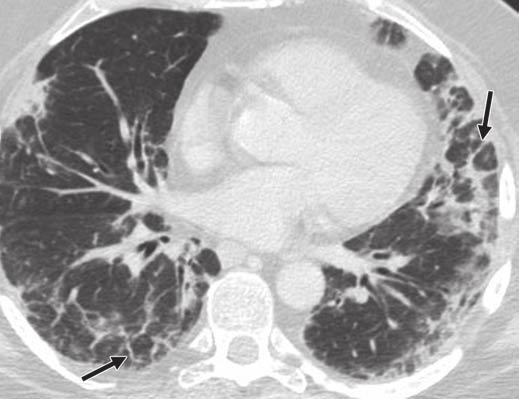 CT of Interstitial Pneumonia Fig. 7 58-year-old woman with biopsy-proven cryptogenic organizing pneumonia and history of dyspnea and fever.