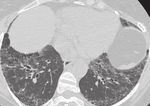 Unenhanced axial high-resolution CT image obtained in prone position through lower lobes reveals combination of ground-glass opacities, bronchiectasis, and peripheral honeycombing.