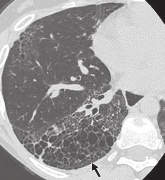 Unenhanced axial high-resolution CT image obtained in prone position through lower lungs shows scattered ground-glass opacities that are relatively symmetric in distribution, accompanied by