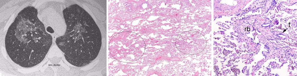 (b) The dusty cobwebs of NSIP pattern are evident in this case of mixed cellular and fibrotic NSIP.