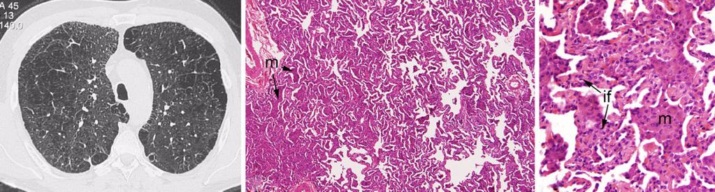 Pathology of the IIP 879 and histopathology has come to be referred to as RB-ILD.
