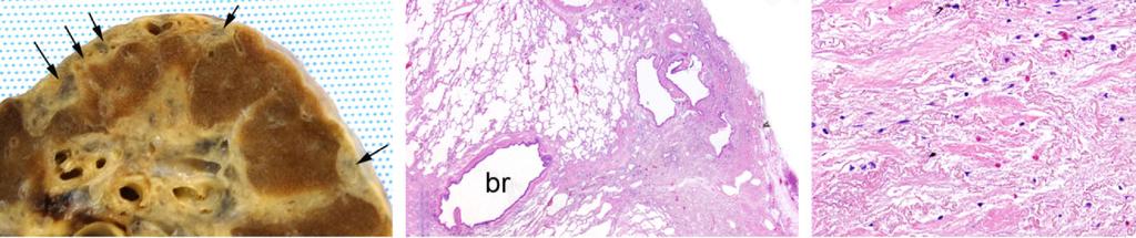 Pathology of the IIP 881 RARE HISTOLOGICAL PATTERNS Two rare histological interstitial pneumonia patterns (acute fibrinous and organizing pneumonia (AFOP) and bronchiolocentric interstitial