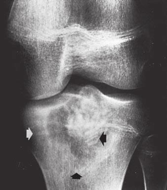 Eisenberg Chondroblastoma Chondroblastoma (Fig. 19) is the classic epiphyseal lesion, which occurs in children and young adults before enchondral bone growth ceases.
