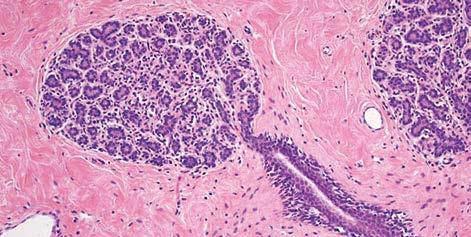 Panel C shows multifocal atypical hyperplasia (in this case, atypical lobular hyperplasia).