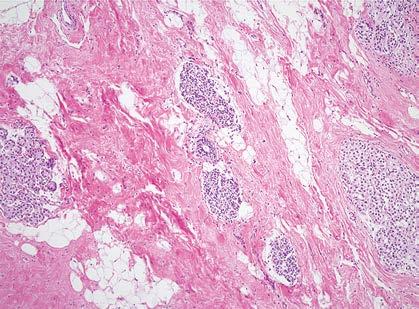 lobular unit. tensive and is associated with a higher risk of breast cancer (relative risk, 8 to 10).