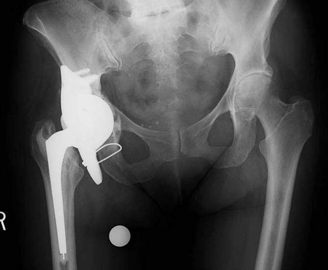Managing massive periacetabular bone loss during revision total hip arthroplasty (THA) has been an ongoing challenge for orthopedic surgeons.
