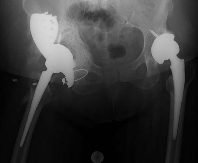 Custom Triflange Component for Acetabular Bone Loss Wind et al 4A Figure 4: Bilateral radiographs showing catastrophic failure of revision total hip arthroplasty with severe Paprosky type 3B/AAOS