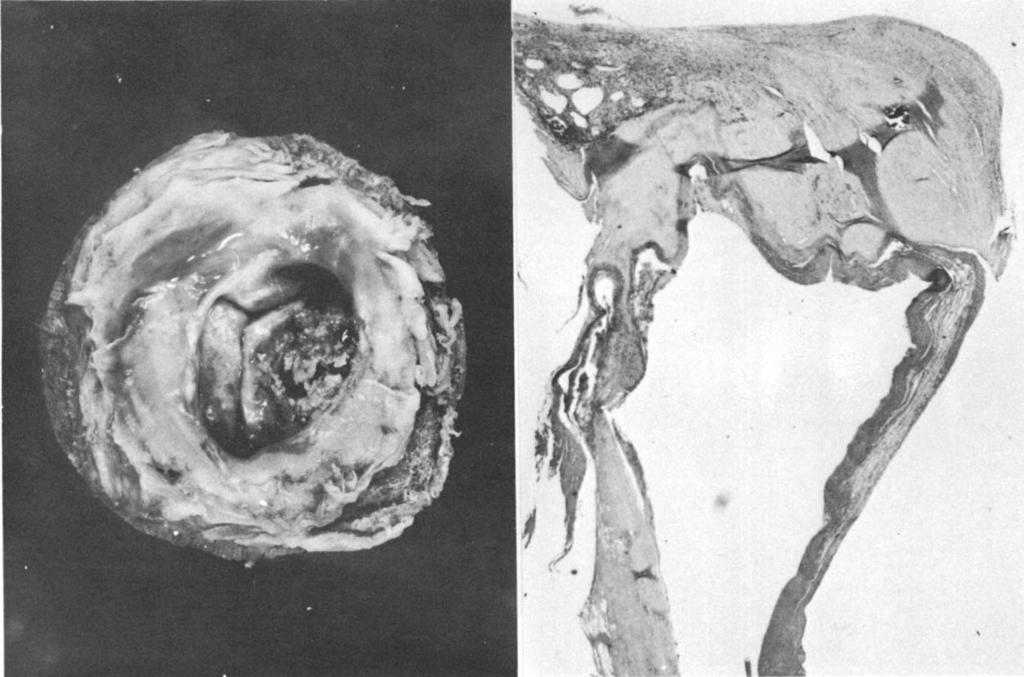 573 Gallucci et al: Isolated MVR with Hancock ioprosthesis A Fig 2. (A)Atrial v i m of a mitral porcine xenograft explanted after 133 months.