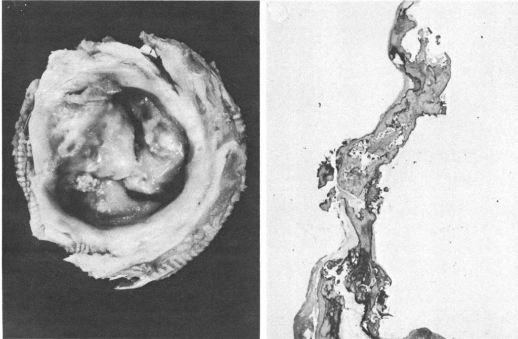 574 The Annals of Thoracic Surgery Vol 38 No 6 December 1984 A Fig 3. (A)Atrial aspect ofa mitral bioprosthesis explanted after 111 months because of severe stenosis.