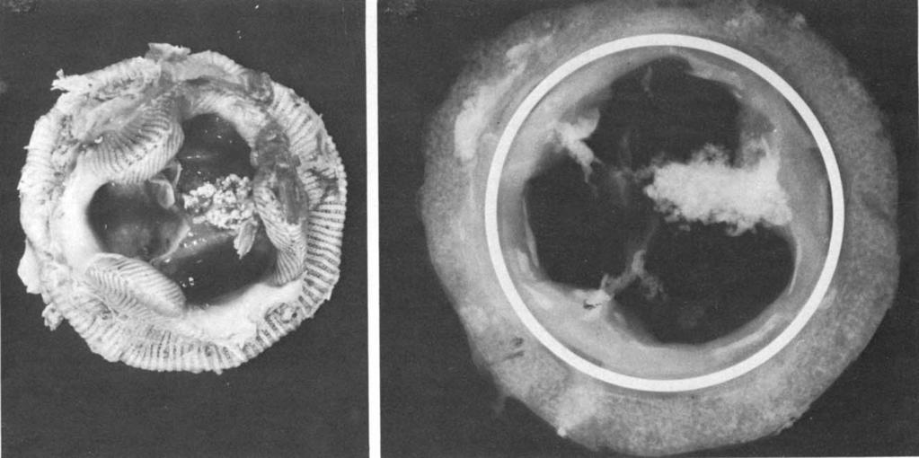 575 Gallucci et al: Isolated MVR with Hancock ioprosthesis A Fig 4. ( A ) Ventricular aspect of a niitral porcine valve recovered at reoperation after 84 months.
