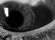 Eye Disorders: Non-Vision Threatening