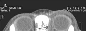 subperiosteal abscess Complications: optic nerve damage,