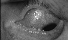 drainage Scleritis BORING PAIN, wakes patient up from