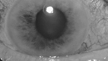 Acute Angle-Closure Glaucoma Characterized by a sudden rise in IOP in a susceptible individual with a dilated pupil Signs & Symptoms Severe ocular pain Frontal headache Blurred vision Halos around